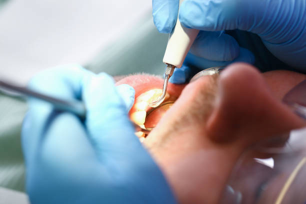 Best Emergency Tooth Extraction in Summerville, SC